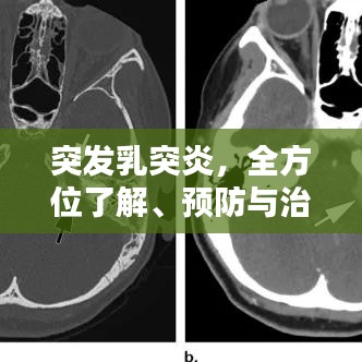 突发乳突炎，全方位了解、预防与治疗策略